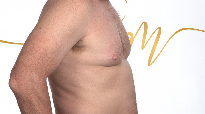 Imagem Ginecomastia
